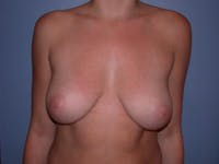 Inverted Nipple Repair Gallery Before & After Gallery - Patient 4757220 - Image 1