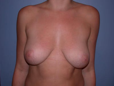 Inverted Nipple Repair Gallery Before & After Gallery - Patient 4757220 - Image 1
