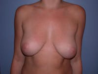 Inverted Nipple Repair Before & After Gallery - Patient 4757220 - Image 1