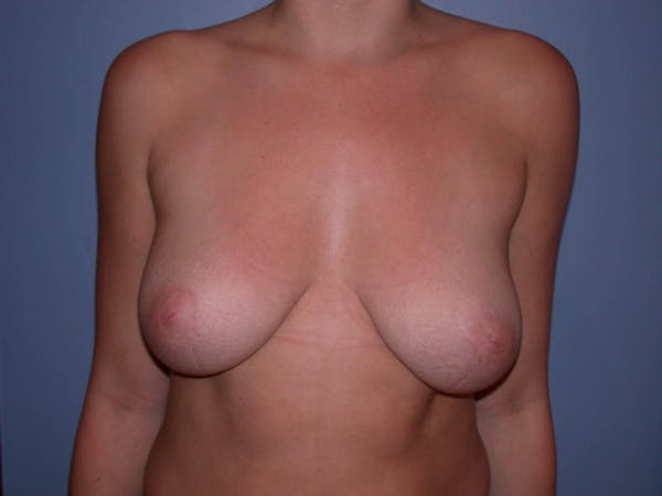 Inverted Nipple Repair Before & After Gallery - Patient 4757220 - Image 1