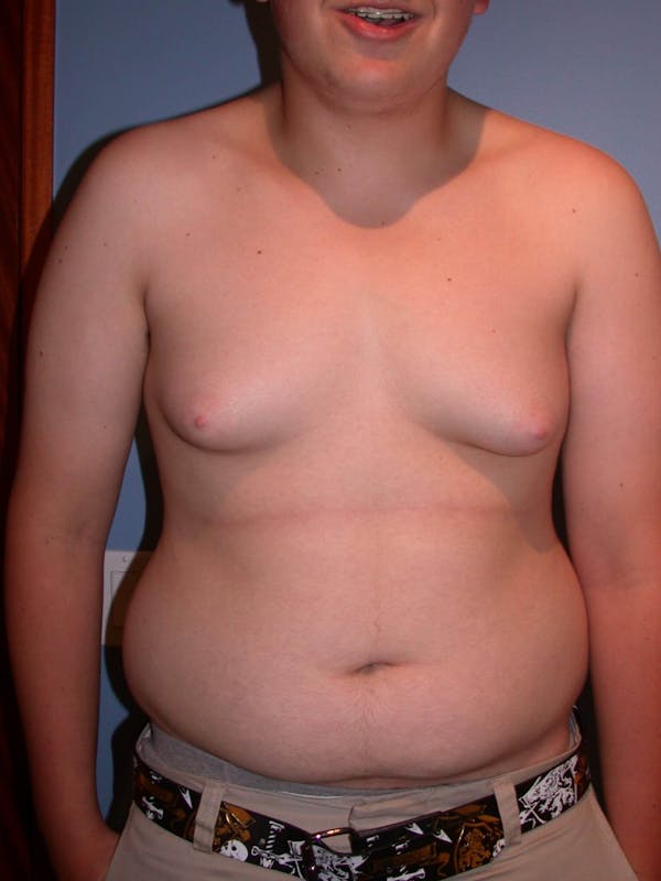 Before Gynecomastia