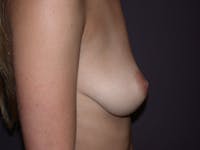 Inverted Nipple Repair Before & After Gallery - Patient 4757224 - Image 1
