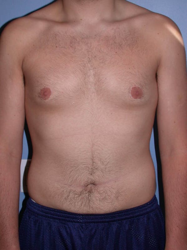 After Gynecomastia