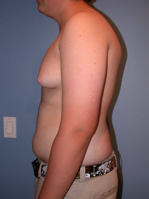 Gynecomastia Gallery Before & After Gallery - Patient 4757227 - Image 3