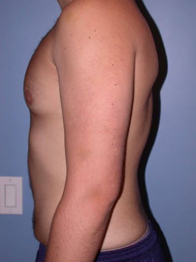 Gynecomastia Gallery Before & After Gallery - Patient 4757227 - Image 4