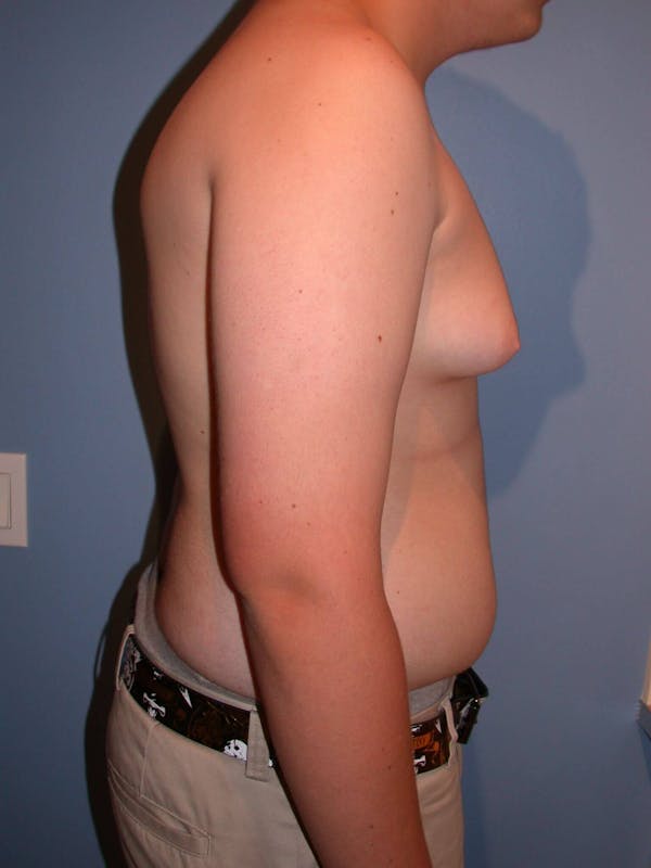 Gynecomastia Gallery Before & After Gallery - Patient 4757227 - Image 5