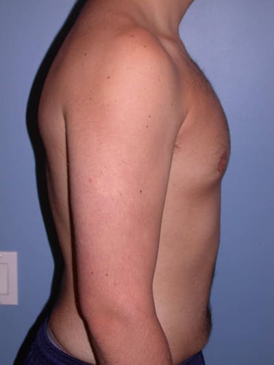 Gynecomastia Gallery Before & After Gallery - Patient 4757227 - Image 6