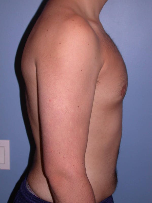 Gynecomastia Gallery Before & After Gallery - Patient 4757227 - Image 6