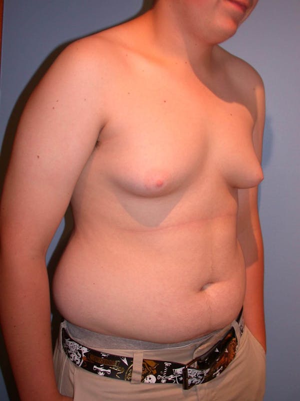 Gynecomastia Gallery Before & After Gallery - Patient 4757227 - Image 7