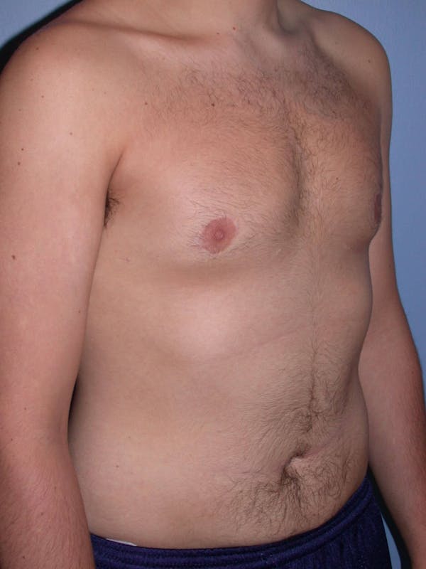 Gynecomastia Gallery Before & After Gallery - Patient 4757227 - Image 8