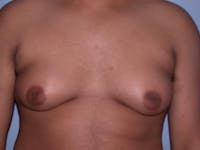 Gynecomastia Gallery - Patient 4757240 - Image 1