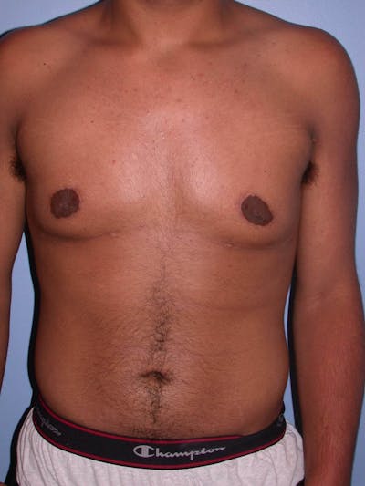 Gynecomastia Gallery Before & After Gallery - Patient 4757240 - Image 2