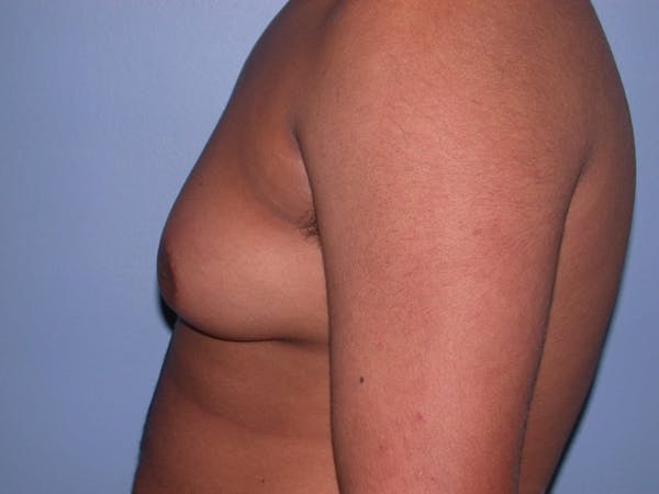 Gynecomastia Gallery Before & After Gallery - Patient 4757240 - Image 3