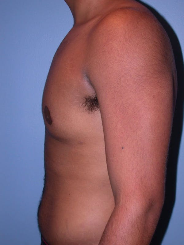 Gynecomastia Gallery Before & After Gallery - Patient 4757240 - Image 4