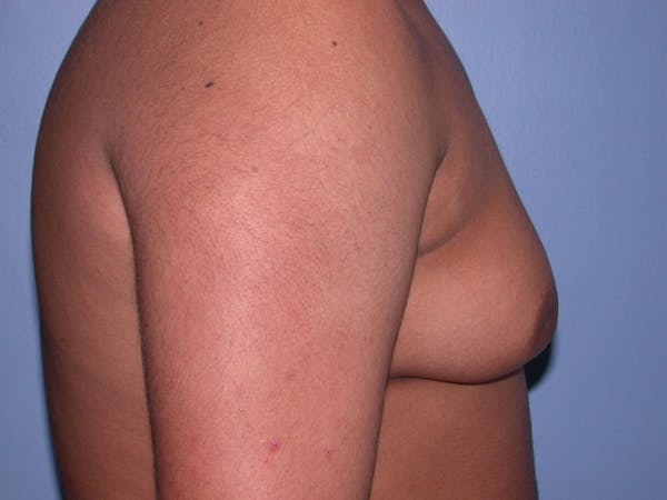 Gynecomastia Gallery Before & After Gallery - Patient 4757240 - Image 5