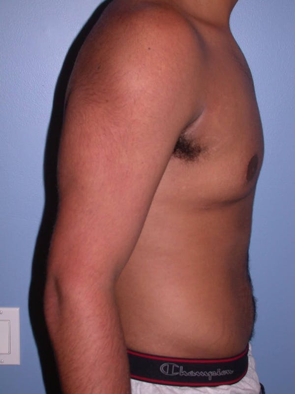 Gynecomastia Gallery Before & After Gallery - Patient 4757240 - Image 6