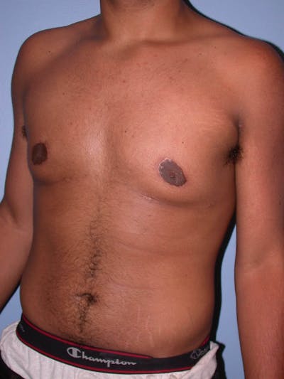 Gynecomastia Gallery Before & After Gallery - Patient 4757240 - Image 8