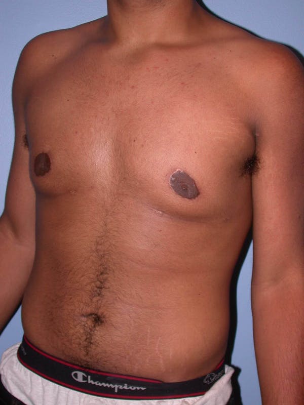 Gynecomastia Gallery Before & After Gallery - Patient 4757240 - Image 8