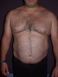 Gynecomastia Gallery Before & After Gallery - Patient 4757249 - Image 1