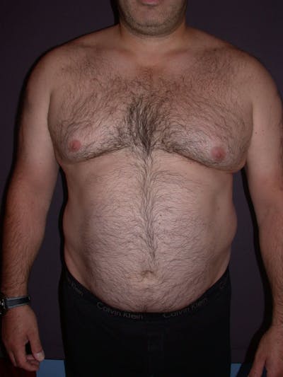 Gynecomastia Gallery Before & After Gallery - Patient 4757249 - Image 1