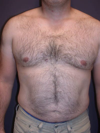 Gynecomastia Gallery Before & After Gallery - Patient 4757249 - Image 2