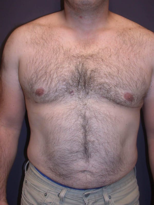 Gynecomastia Before & After Gallery - Patient 4757249 - Image 2