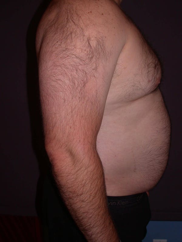 Gynecomastia Gallery Before & After Gallery - Patient 4757249 - Image 3