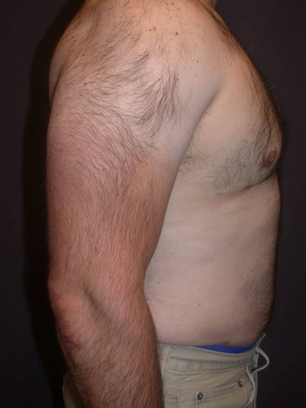 Gynecomastia Gallery Before & After Gallery - Patient 4757249 - Image 4