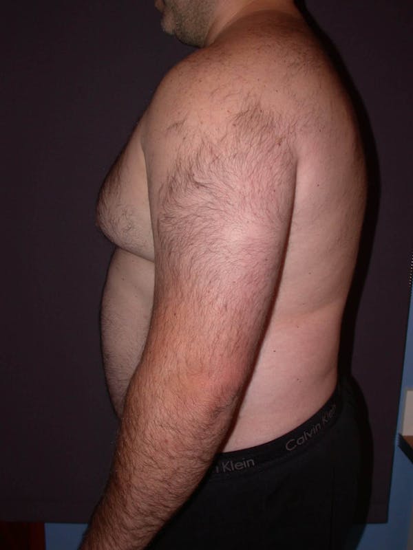 Gynecomastia Gallery Before & After Gallery - Patient 4757249 - Image 5