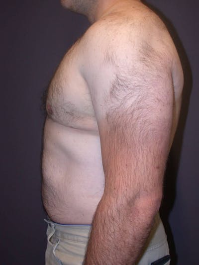 Gynecomastia Gallery Before & After Gallery - Patient 4757249 - Image 6