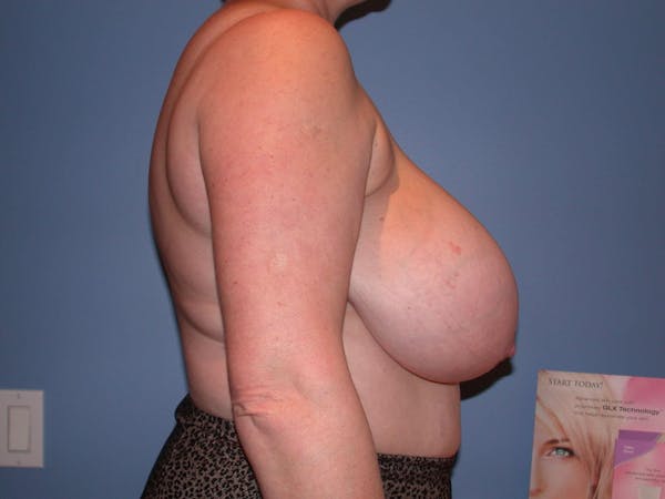 Breast Reduction Gallery Before & After Gallery - Patient 4757272 - Image 3