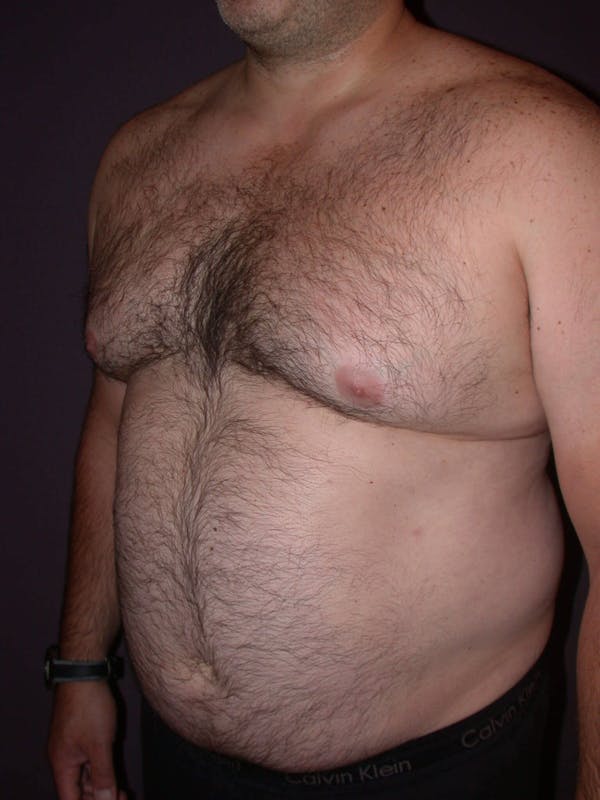 Gynecomastia Gallery Before & After Gallery - Patient 4757249 - Image 7