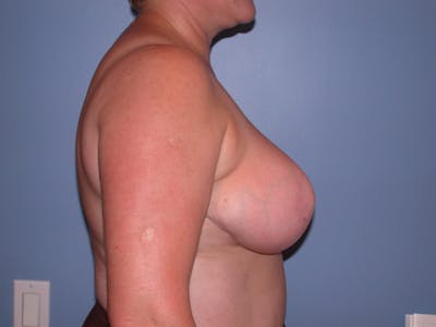 Breast Reduction Gallery Before & After Gallery - Patient 4757272 - Image 4