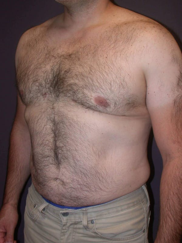 Gynecomastia Gallery Before & After Gallery - Patient 4757249 - Image 8