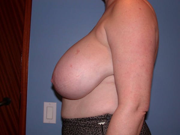 Breast Reduction Gallery Before & After Gallery - Patient 4757272 - Image 5
