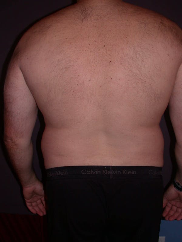 Gynecomastia Gallery Before & After Gallery - Patient 4757249 - Image 9