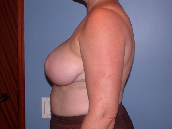 Breast Reduction Gallery Before & After Gallery - Patient 4757272 - Image 6