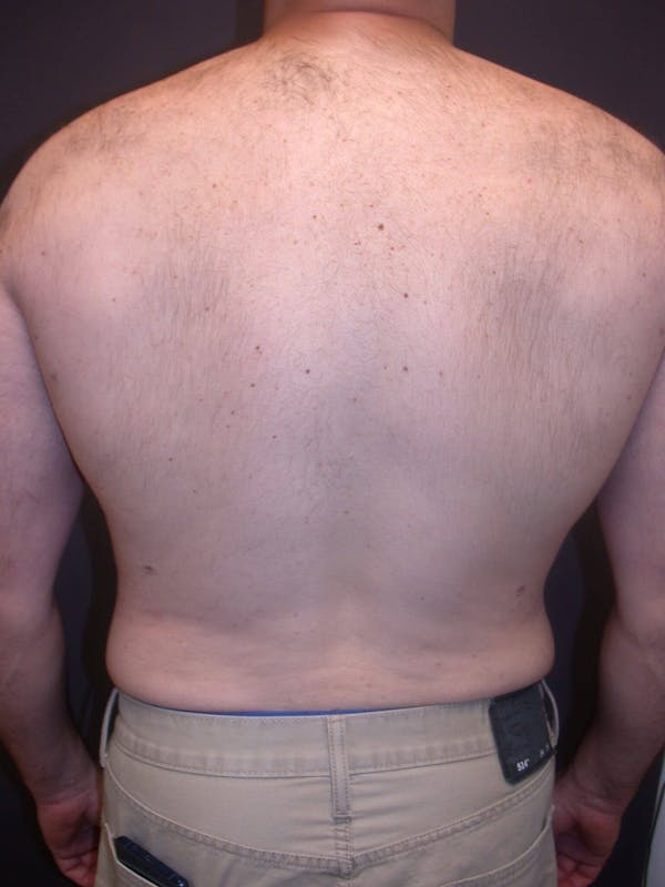 Gynecomastia Gallery Before & After Gallery - Patient 4757249 - Image 10