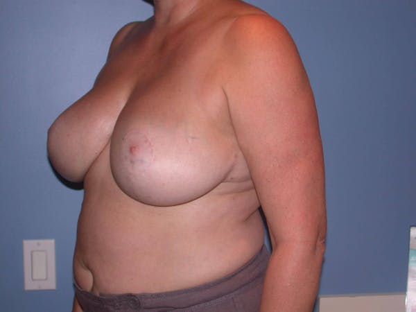 Breast Reduction Gallery Before & After Gallery - Patient 4757272 - Image 8