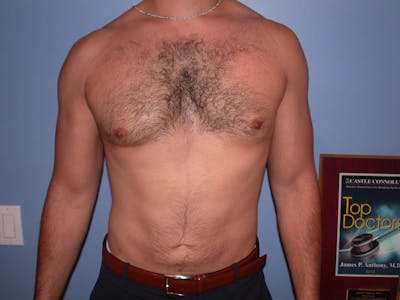 Gynecomastia Gallery Before & After Gallery - Patient 4757278 - Image 2