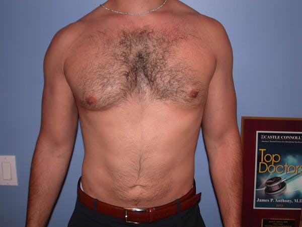 Gynecomastia Before & After Gallery - Patient 4757278 - Image 2