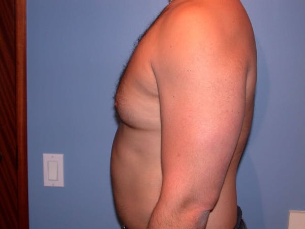 Gynecomastia Gallery Before & After Gallery - Patient 4757278 - Image 3