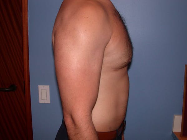 Gynecomastia Gallery Before & After Gallery - Patient 4757278 - Image 6