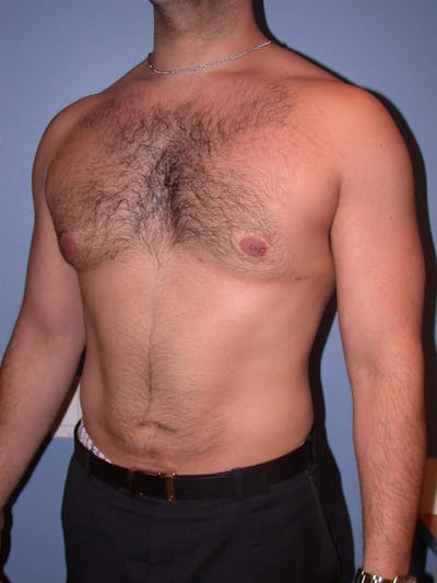 Gynecomastia Gallery Before & After Gallery - Patient 4757278 - Image 8