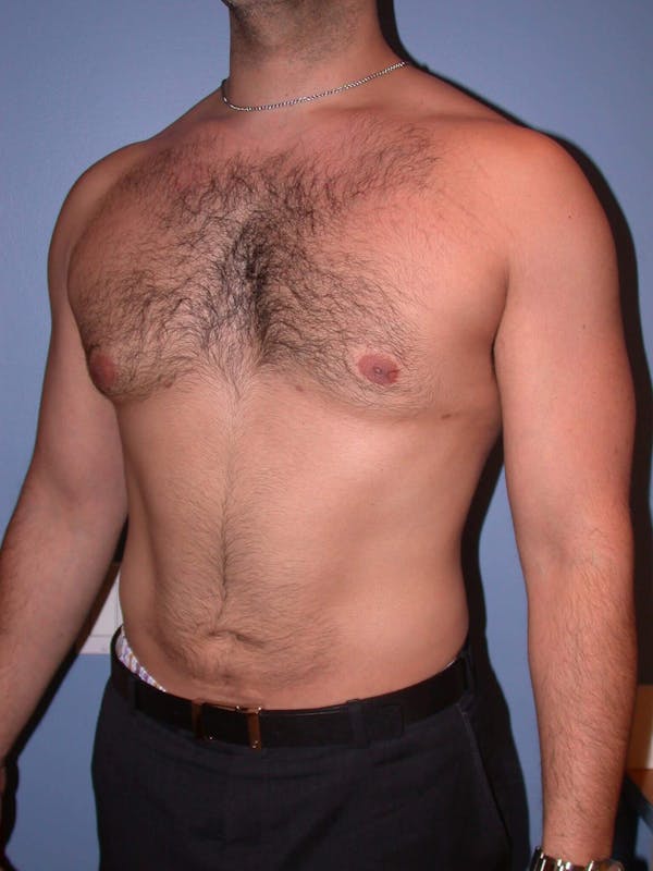 Gynecomastia Before & After Gallery - Patient 4757278 - Image 8