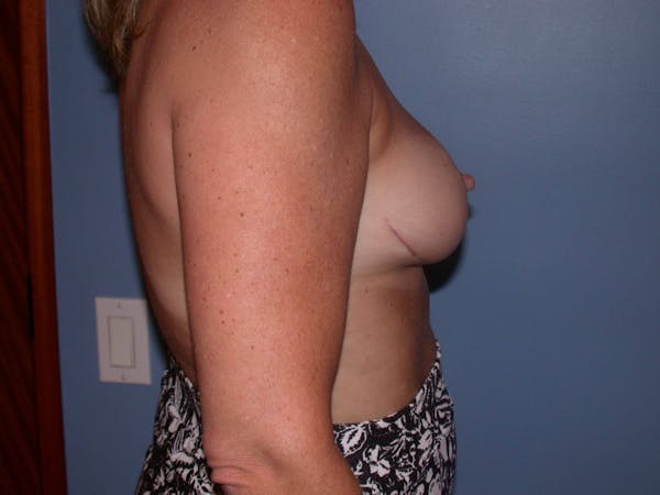 Breast Reduction Gallery Before & After Gallery - Patient 4757282 - Image 6