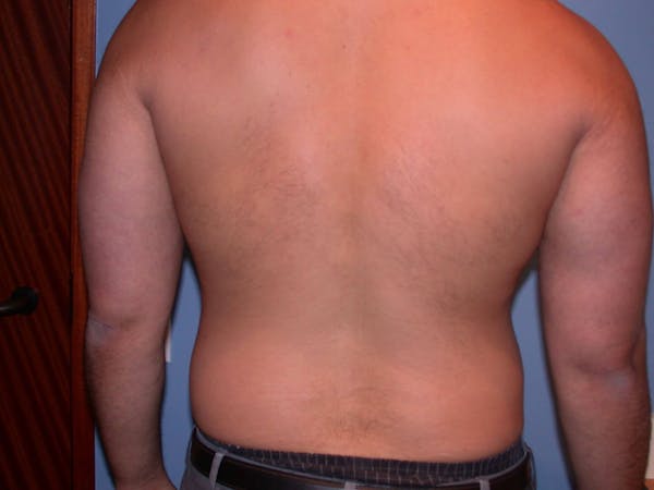 Gynecomastia Gallery Before & After Gallery - Patient 4757278 - Image 9