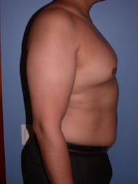 Gynecomastia Gallery Before & After Gallery - Patient 4757286 - Image 1