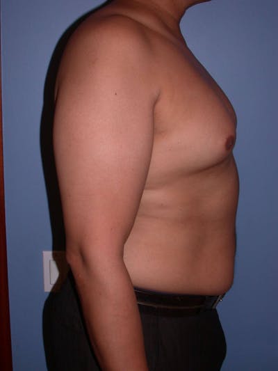 Gynecomastia Gallery Before & After Gallery - Patient 4757286 - Image 1