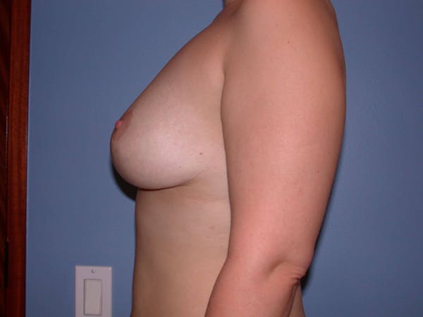 Breast Lift Gallery Before & After Gallery - Patient 4757284 - Image 4